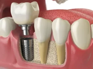 Cosmetic Dentistry Secrets: Top 5 Procedures You’ll Want to Try