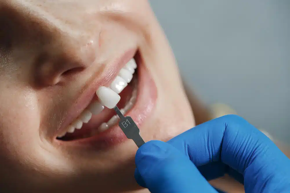 Close-up of a dental professional's gloved hand holding a color shade guide next to a patient's mouth, showcasing a dental veneer fitting process for cosmetic enhancement.