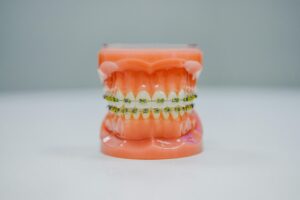 Best Age to Get Braces: The Ultimate Guide for Parents