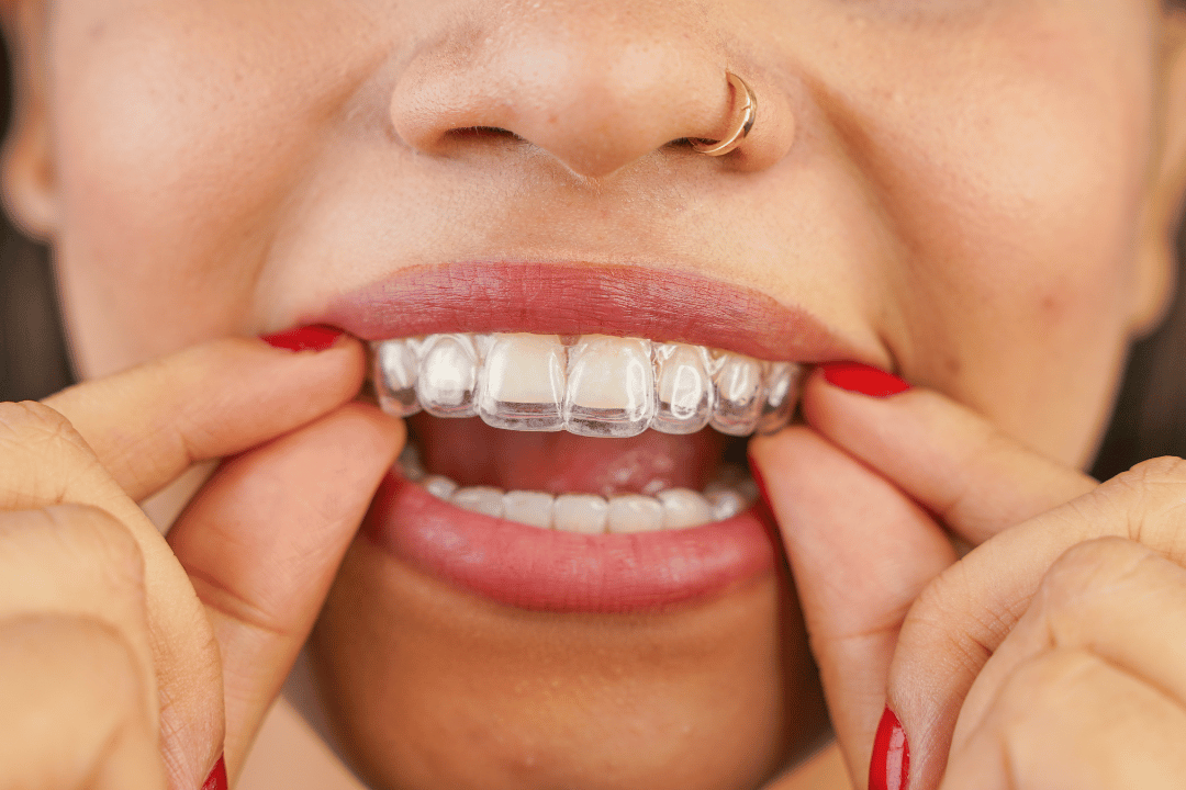 adult patient during Invisalign fitting