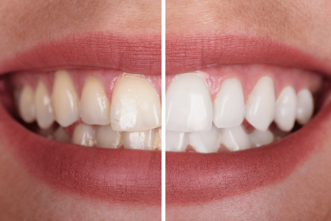 Porcelain Veneers vs. No-Prep Veneers: Which One Is Right for You?