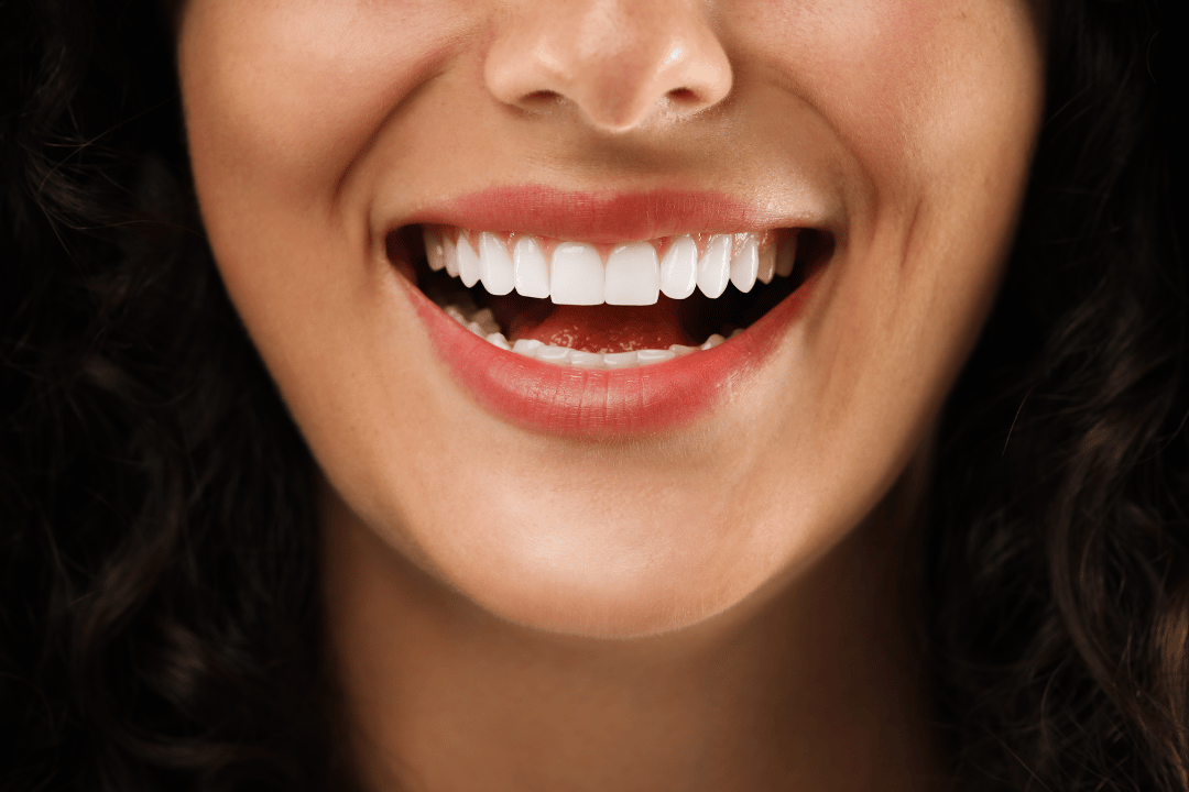 close-up of no-prep veneers