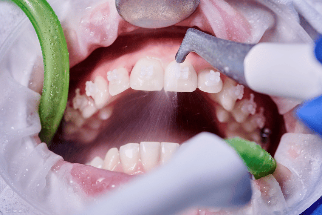 dental cleaning session brooklyn
