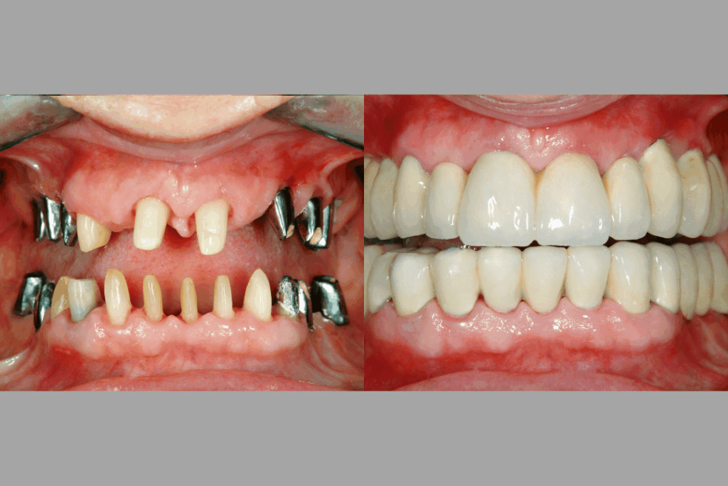 before after dental implant