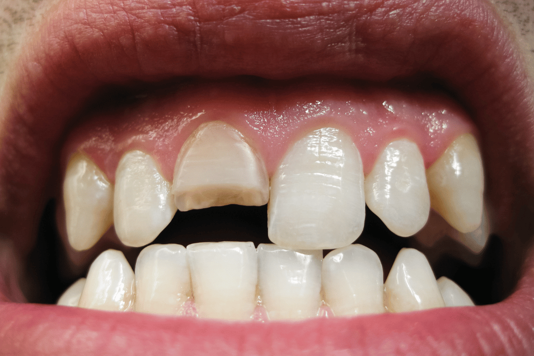 broken tooth at night brooklyn