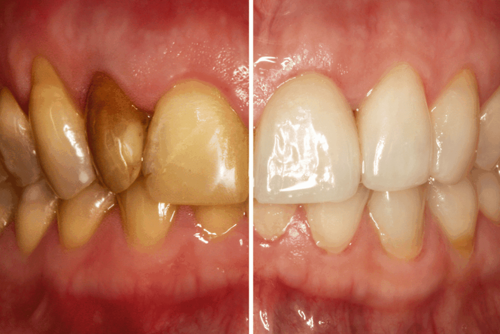 missing tooth solution