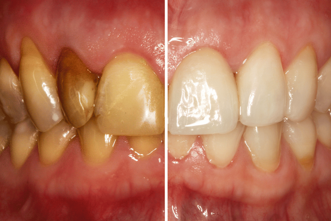 missing tooth solution brooklyn