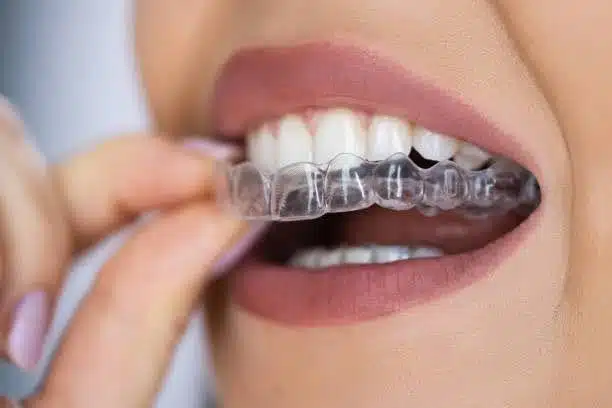 clear-aligner-close-up-Bedford-Stuyvesant -ny A close-up image of a clear aligner