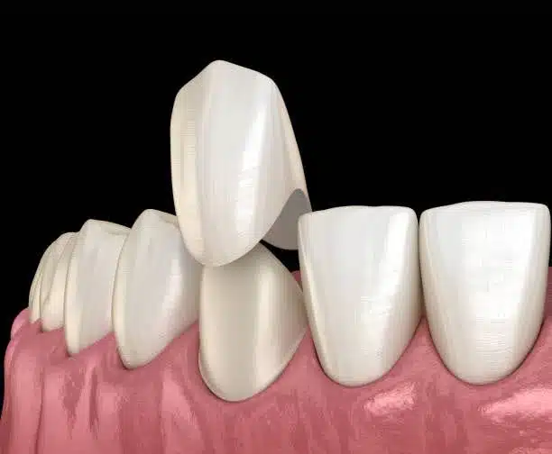 porcelain-veneers-tooth-model Close-up of porcelain veneers placed on a tooth model