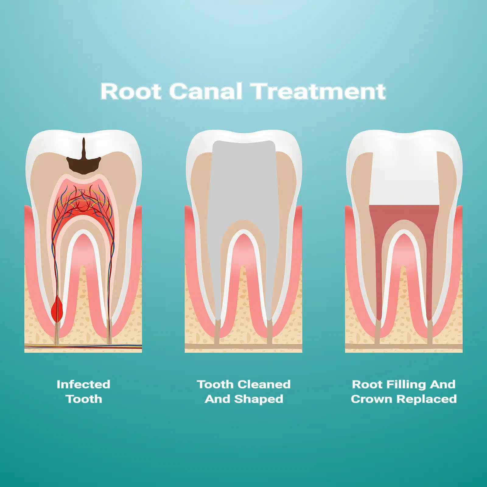 Tooth diagram showing infected pulp and root canal treatment steps