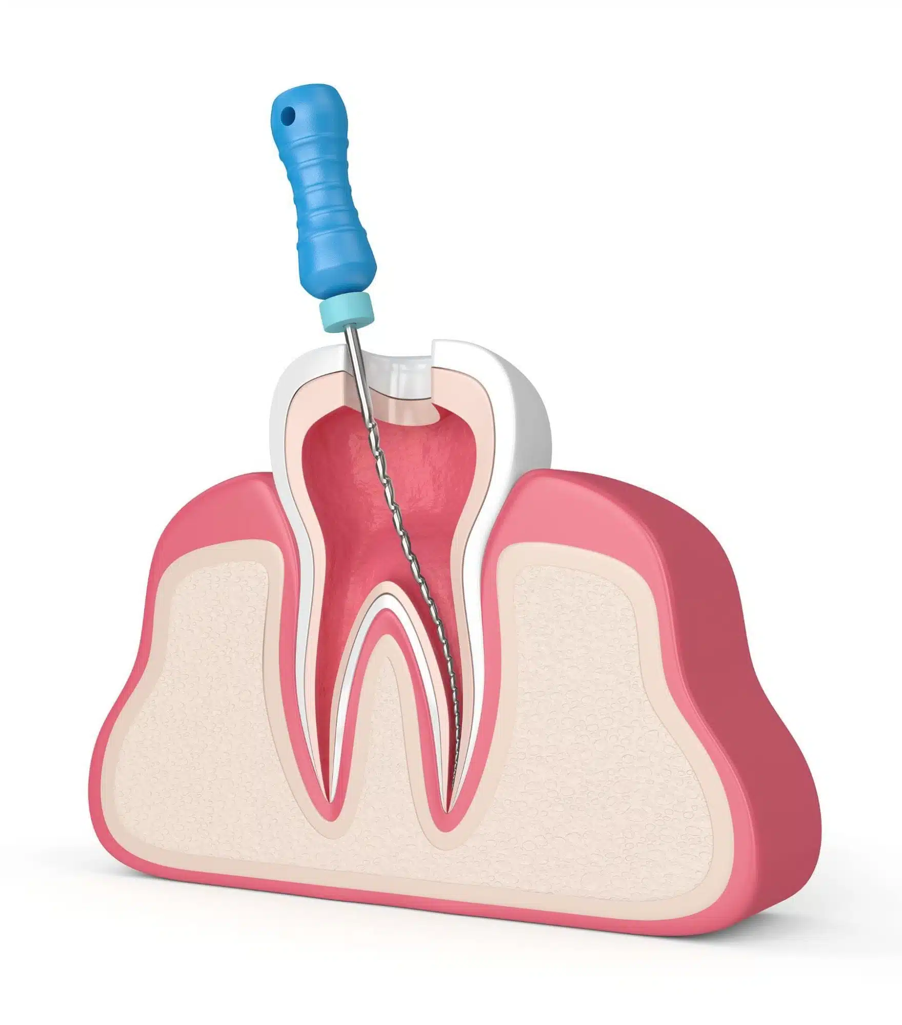 transverse section of root canal treatment