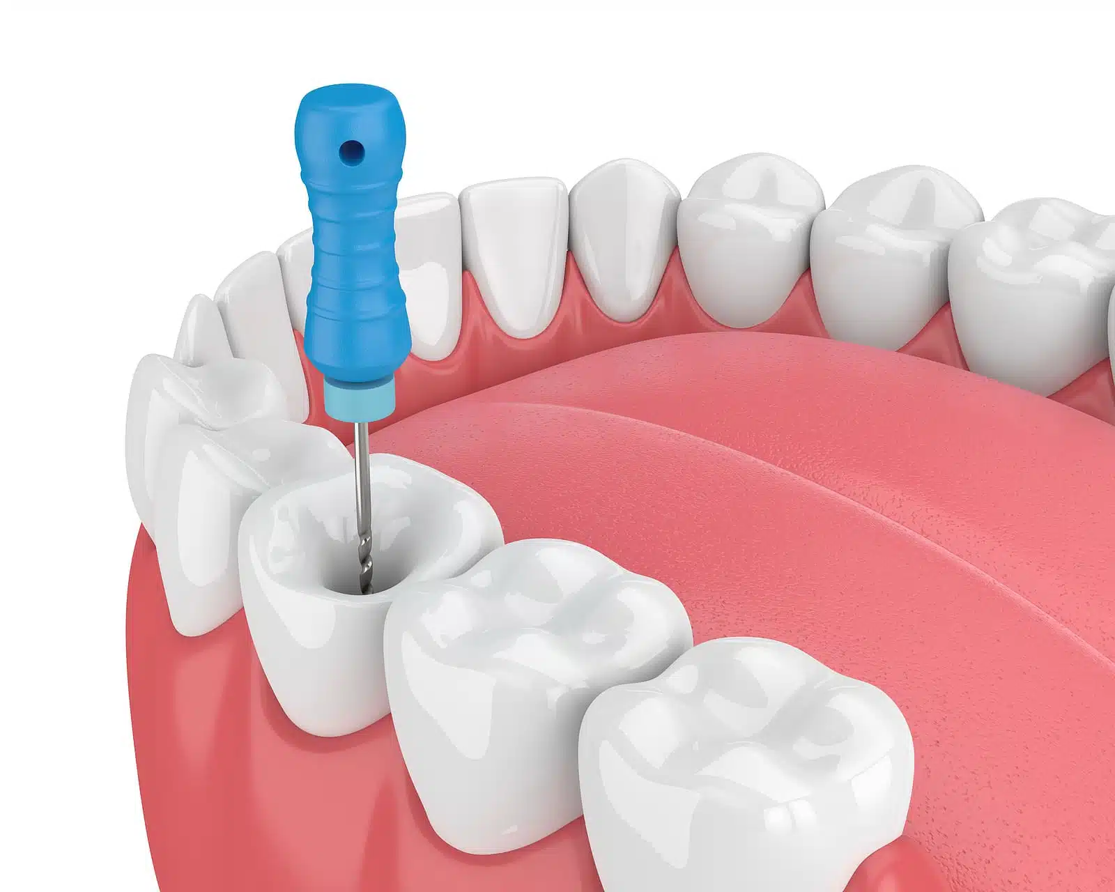 3d model of root canal treatment