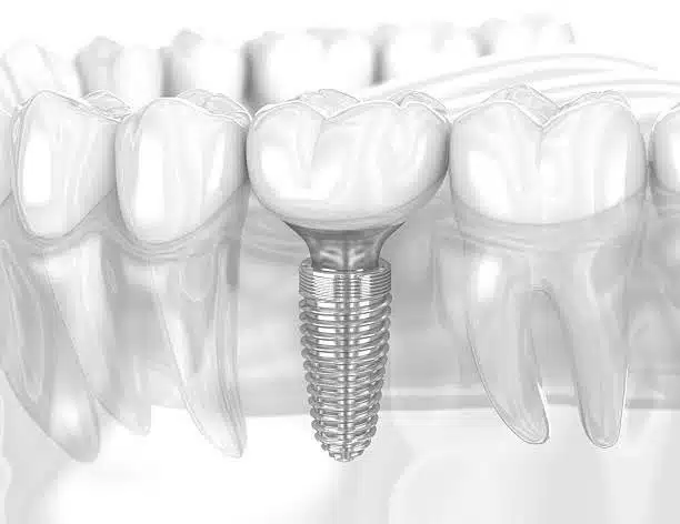 tooth-replacement-near-Bedford-Stuyvesant-implant-restoration Close-up of natural-looking implant-supported tooth replacement near Bedford-Stuyvesant