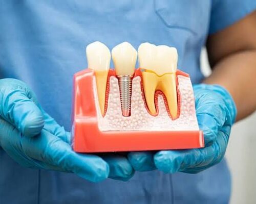 Close-up of a dental implant model showing implant placement and crown restoration