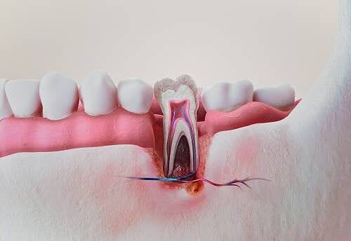 infected-tooth-treatment-model Close-up of a tooth model used to explain what an infected root canal looks like