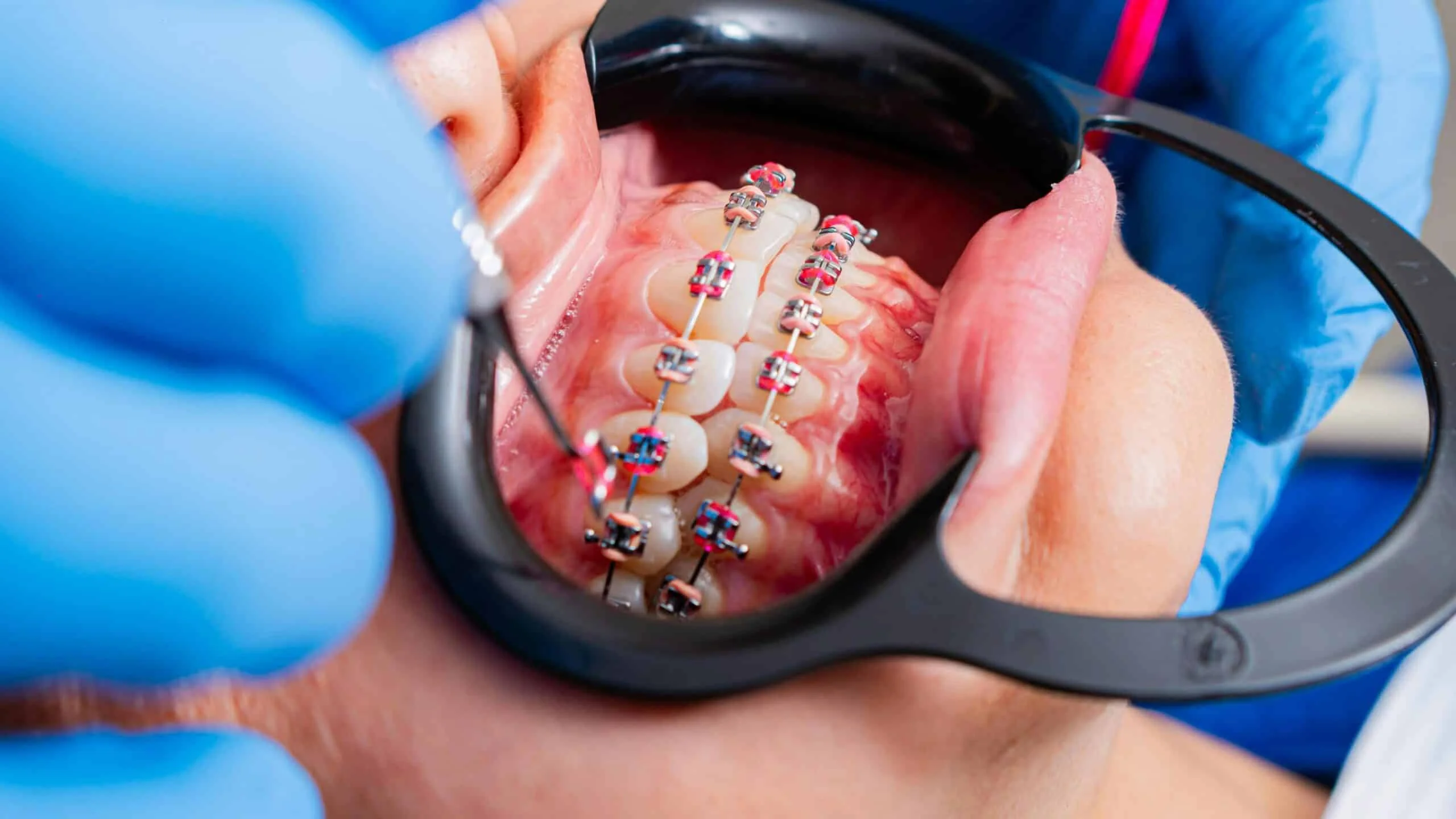 How Much is the Cost of Orthodontic Braces in Brooklyn?