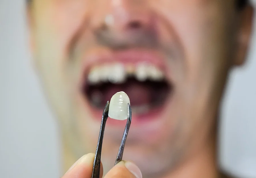 Can You Get Veneers With Missing Teeth? What You Need to Know